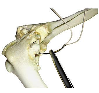 CRUCIATE NEEDLES 25 MM 100 LB